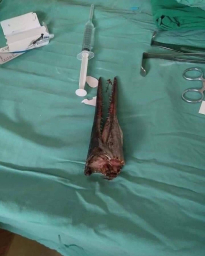 혐) 사람 목을 관통해버린 물고기