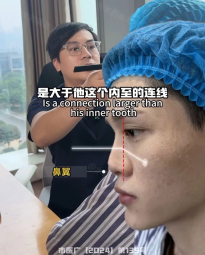 남자 코성형 레전드